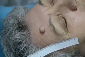 皮肤痣的切除视频封面