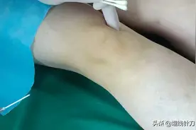 玻璃酸钠的膝关节腔注射视频封面