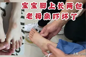 三岁男童脚上突然鼓两包，一家人去找医生 问问到底咋回事？视频封面