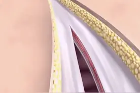 腹膜的连续缝合