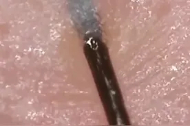 放大镜下看每根毛发拔出的过程 