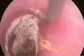 耳道耵聍的清理