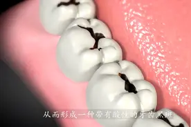 蛀牙是被“虫子”吃空的吗? 3D动画告诉我们答案!“虫儿”长这样