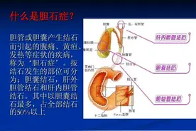 胆结石吃什么可以化掉？本文为你揭开不动手术治疗胆结石的真相图片