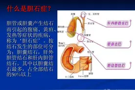 胆结石吃什么可以化掉？本文为你揭开不动手术治疗胆结石的真相图片