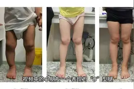腿不直一定有问题吗？视频封面