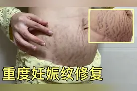 【产后日记】94年深圳宝妈重度妊娠纹第三次治疗修复全过程视频封面