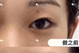 改善眼皮松弛下垂，应该做双眼皮？图片