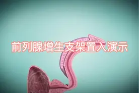 通过放支架治疗前列腺增生，大家觉得可行吗？视频封面