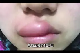 嘴唇反复肿的原因视频封面