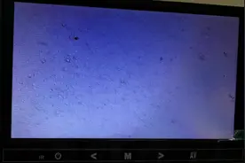广东江门慢性前列腺炎，复查前列腺液卵磷脂小体4+