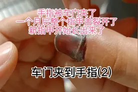 小伙儿手指被车门夹了，一个月后指甲盖边开裂了，长出新指甲