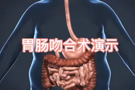 胃肠吻合术过程演示，已收藏！