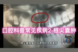 口腔科普常见疾病2-根尖囊肿视频封面