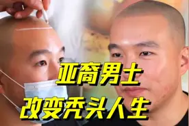 秃头用这招儿！亚裔小伙儿用头皮微色素染色（纹发）重拾发际线视频封面
