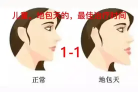 儿童地包天的形成，以及最佳治疗时间视频封面