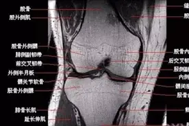 膝关节MR冠状位解剖结构图视频封面
