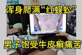 山东37岁王先生，为10年牛皮癣东奔西走无果日夜百愁交集视频封面
