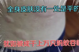无缘无故全身痒痛，哪里都痒手不能停，仿佛全身被虫咬般难受！视频封面