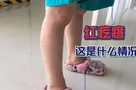 四岁小朋友身上长满红疙瘩，又痒又痛的，这是什么情况？视频封面