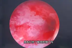 1分钟让你看懂宫腔镜操作视频封面