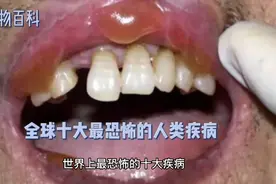 全球十大最恐怖的人类疾病视频封面