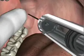 看着真疼，拔牙时怎么麻醉，3D演示。。