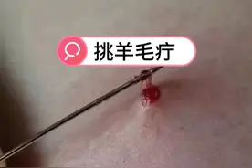 腰间盘突出患者经过挑羊毛疔疗法，能弯腰了！孙利群视频封面