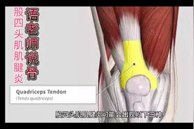 什么是股四头肌肌腱炎？