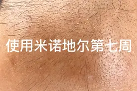 已经使用米诺地尔治疗脱发七周，长的绒毛还没有变成黑而粗的毛发视频封面