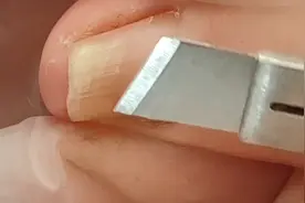 你的指甲长到肉里面了吗？这样卷进去了吗？视频封面