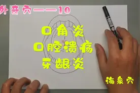 经外奇穴——海泉穴，可以用于口角炎，口腔溃疡，和牙龈炎。