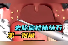 扁桃体结石也是口臭的原因之一哦！这东西超级臭！视频封面