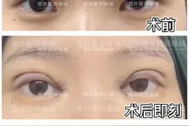 双眼皮案例分享图片