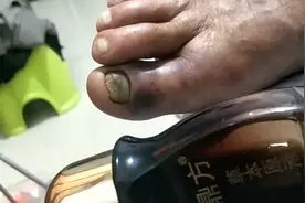 今天干活不小心砸到右脚大母趾，就用鼎方草本原液涂擦来治疗疼痛视频封面