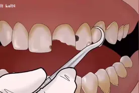 定格动画｜牙医治疗智齿短齿牙垢清洁（声控解压助眠）