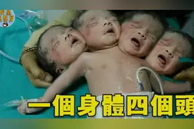 男孩一出生就有四個頭医生断言活不過一岁，他卻創造了奇跡连体人视频封面