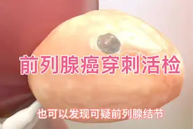 经会阴前列腺穿刺活检动画演示，前列腺癌诊断金标准！视频封面