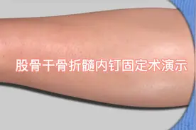 股骨干骨折髓内钉固定术动画演示！