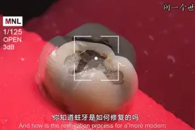 修补一颗蛀牙的全过程演示，不痛不痒非常简单，过程相当的解压视频封面