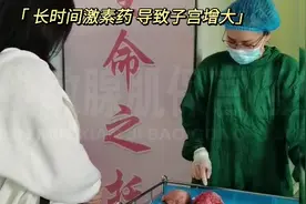 腺肌病史十六年 子宫如孕 病灶如此大 长期激素药所致视频封面