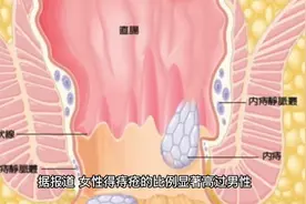 为什么女性容易得痔疮？视频封面