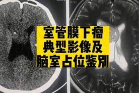 室管膜下瘤典型影像表现，侧脑室肿瘤简单鉴别诊断
