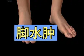 分析一下：脚水肿的原因！视频封面