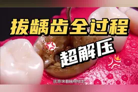拔龋齿全过程！超解压~智齿也是一样的操作流程~