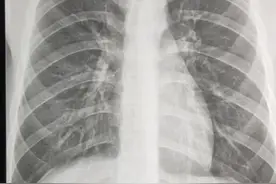 一张正常的胸片视频封面