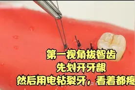 第一视角拔智齿，先划开牙龈，然后用电钻裂牙，看着都疼！疼啊视频封面