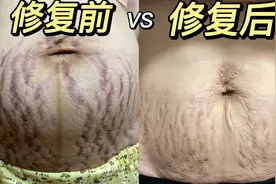 【产后日记】94年深圳宝妈“重度妊娠纹”艰辛治疗修复之路…视频封面