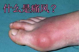 什么是痛风？痛风有哪些症状？
