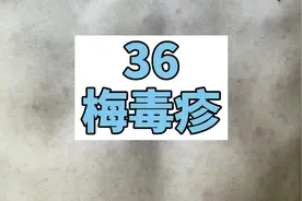 认识梅毒疹：不疼不痒的浸润性红斑，应及时化验。视频封面